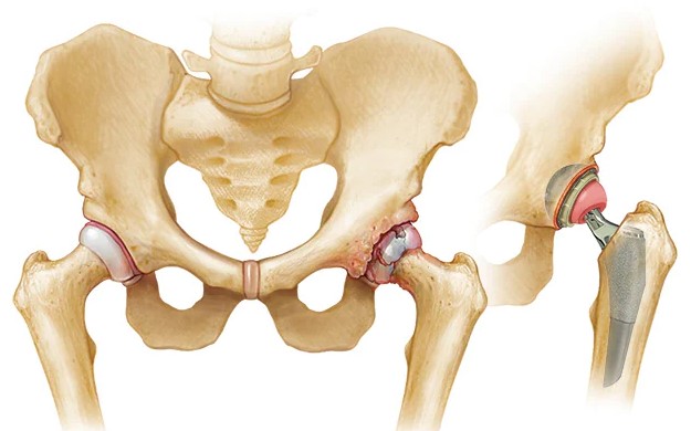 Hip Replacement